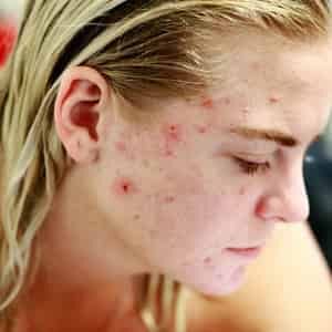 Pimples and Acne